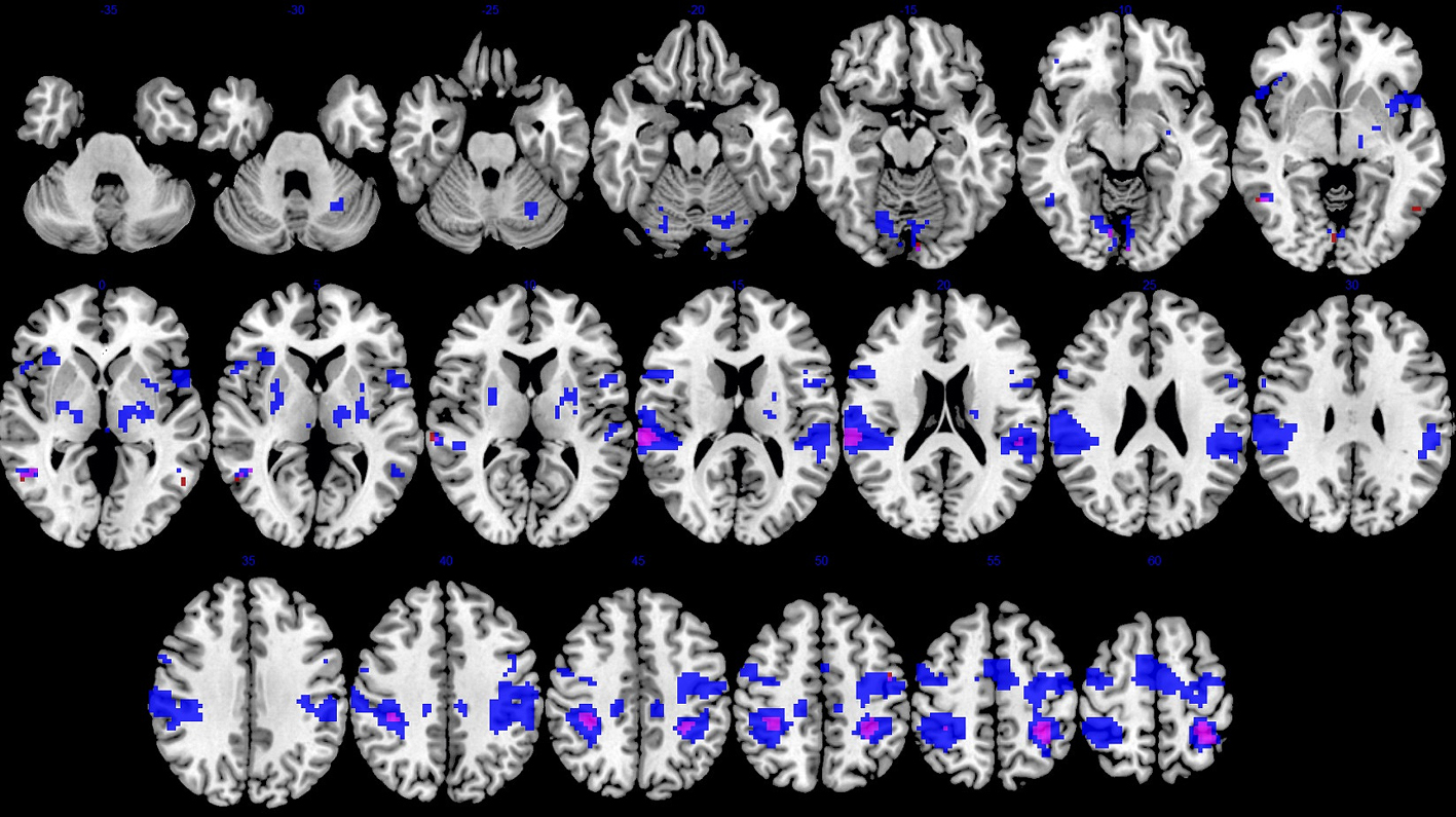 potential-mirror-neurons-change-after-stroke-physiotherapy-research