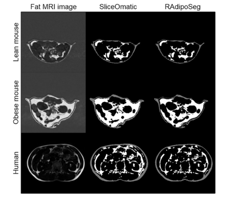 Mri Adipose Tissue Segmentation And Quantification In R (radiposeg 