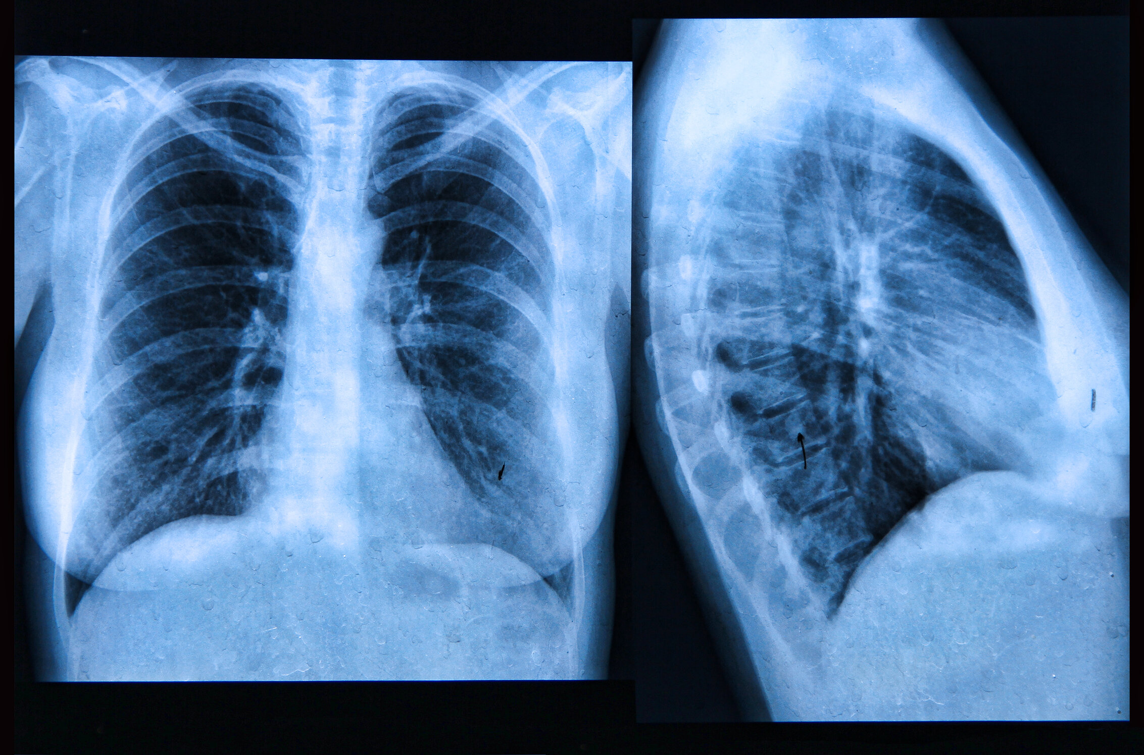 Idiopathic Pulmonary Fibrosis Chest X Ray