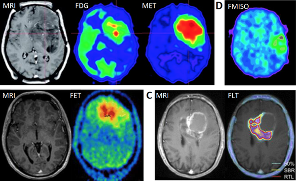 The pictures shows some imaging modalities (MRI and PET) used in the clinic to detect brain tumors and to monitor their progression.