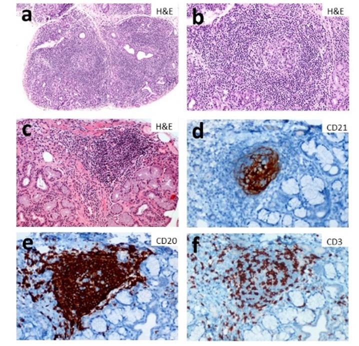 inflammatory cells in the salivary glands