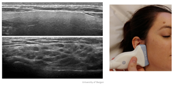 salivary gland ultrasound