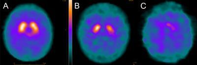 Dopamine transporter (DAT) imaging shows the uptake of a radioactive tracer in the nigrostriatal terminals.