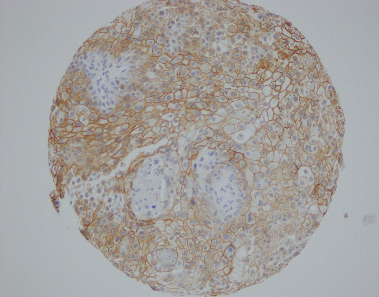Marit's tumor microarray - Nectin4