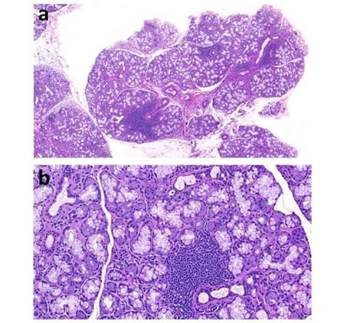 salivary gland biopsies