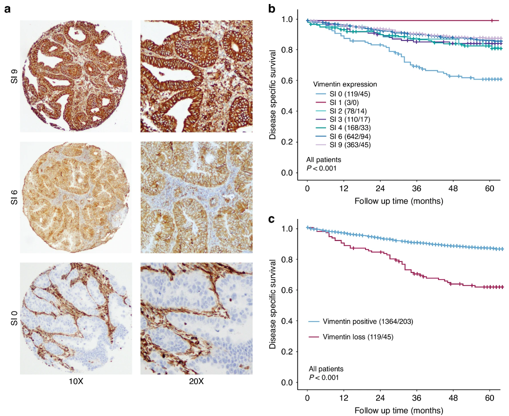 Vimentin expression in endometrial cancer