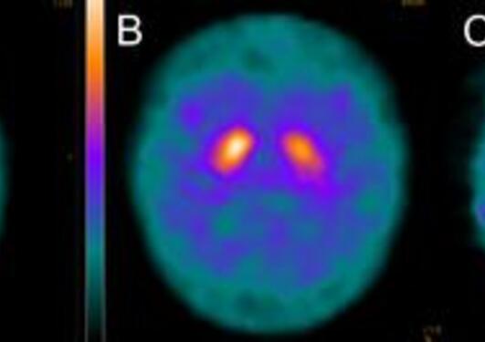 Dopamine transporter (DAT) imaging shows the uptake of a radioactive tracer in the nigrostriatal terminals.