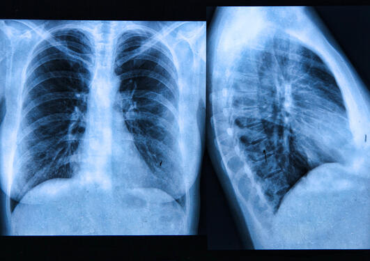 Røntgen av lunger 